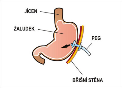Peg İle Beslenen Hasta Yorumları